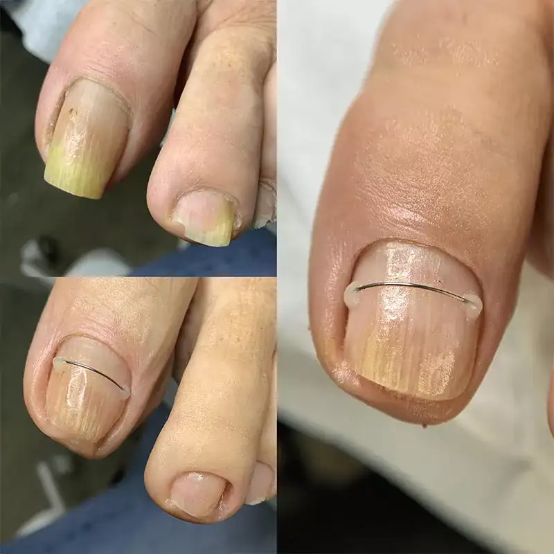 Unghie încarnată — rezultat corecție cu fir de titan