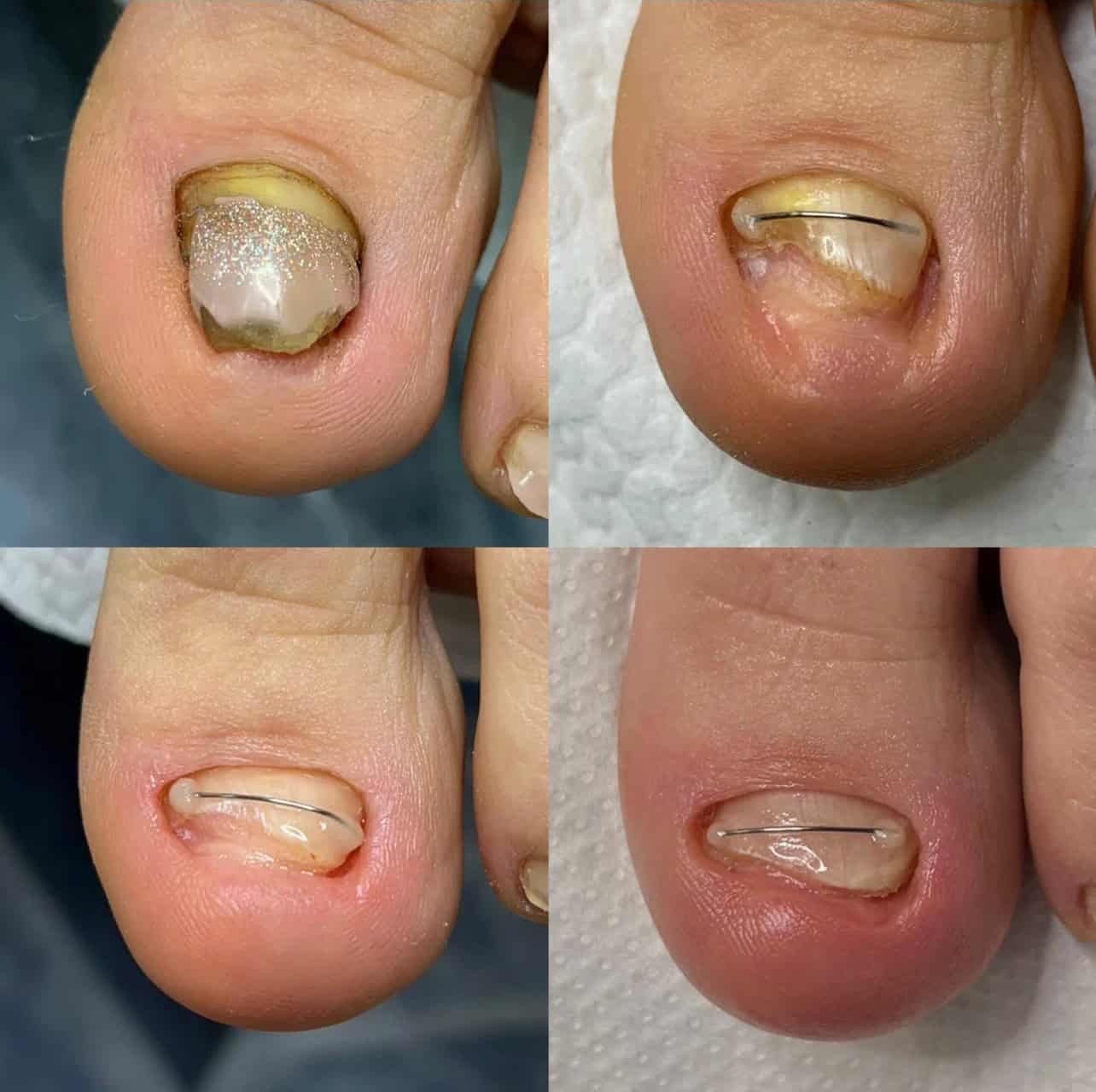 Unghie încarnată — corecție OnyxoShape, rezultat