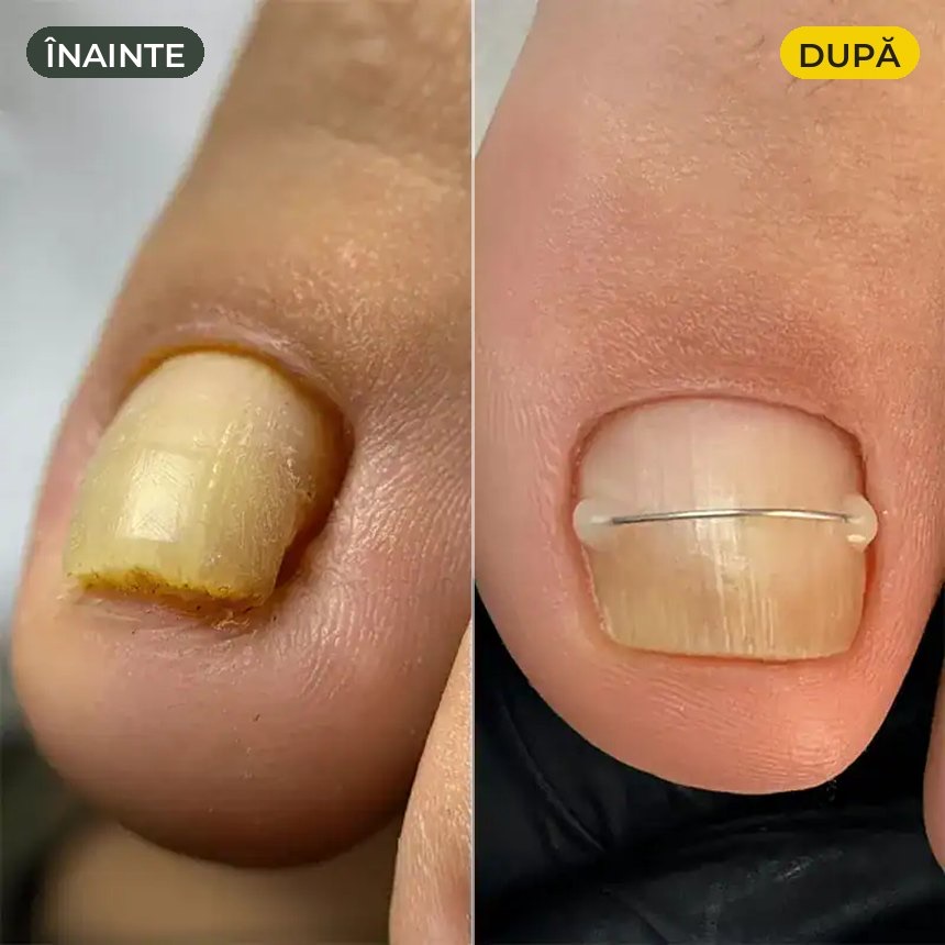 Unghie încarnată — înainte și după corecția cu fir de titan la PodoCliniq