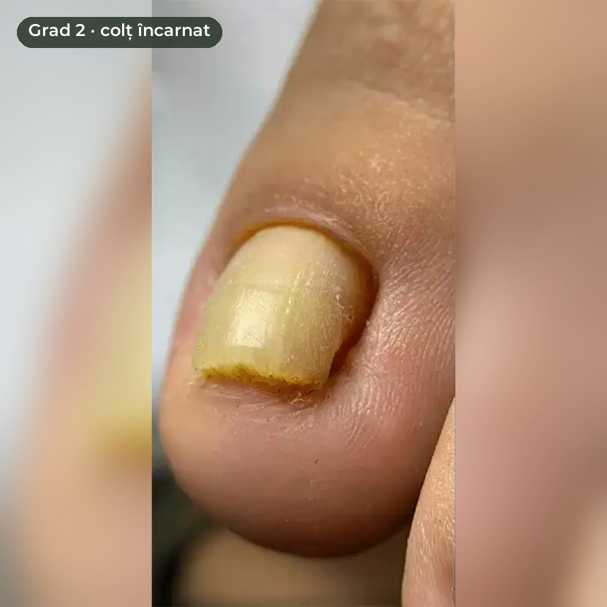 Unghie încarnată grad 2 — colț încarnat