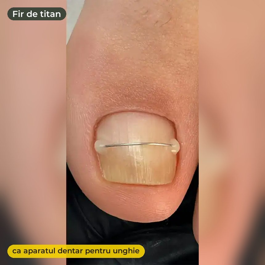Fir de titan pentru corecția unghiei încarnate — ca aparatul dentar pentru unghie
