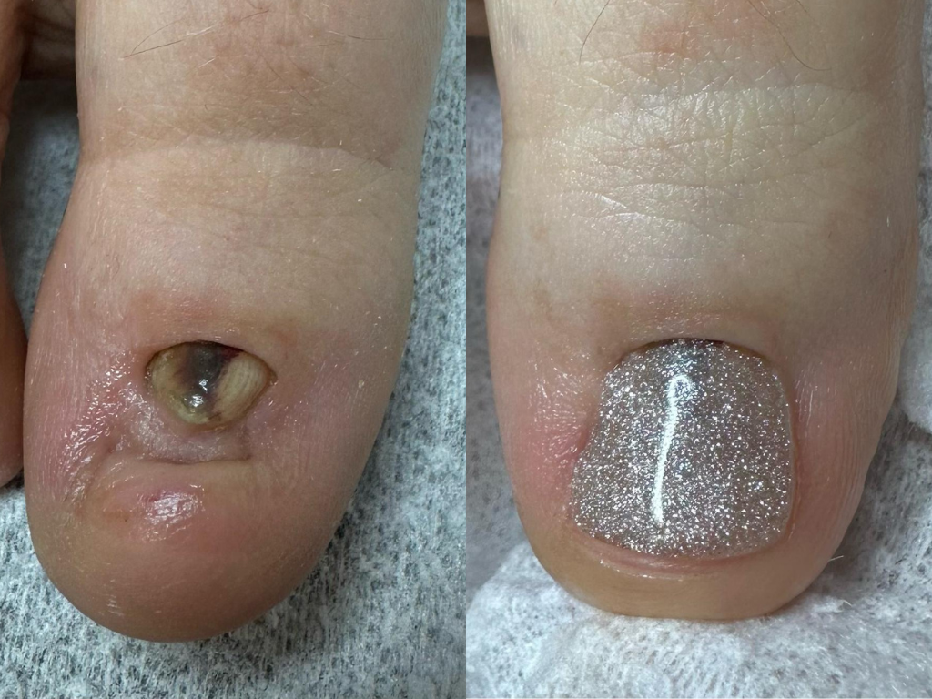 Protezarea unghiei: ce este, când este necesară și cum se realizează?