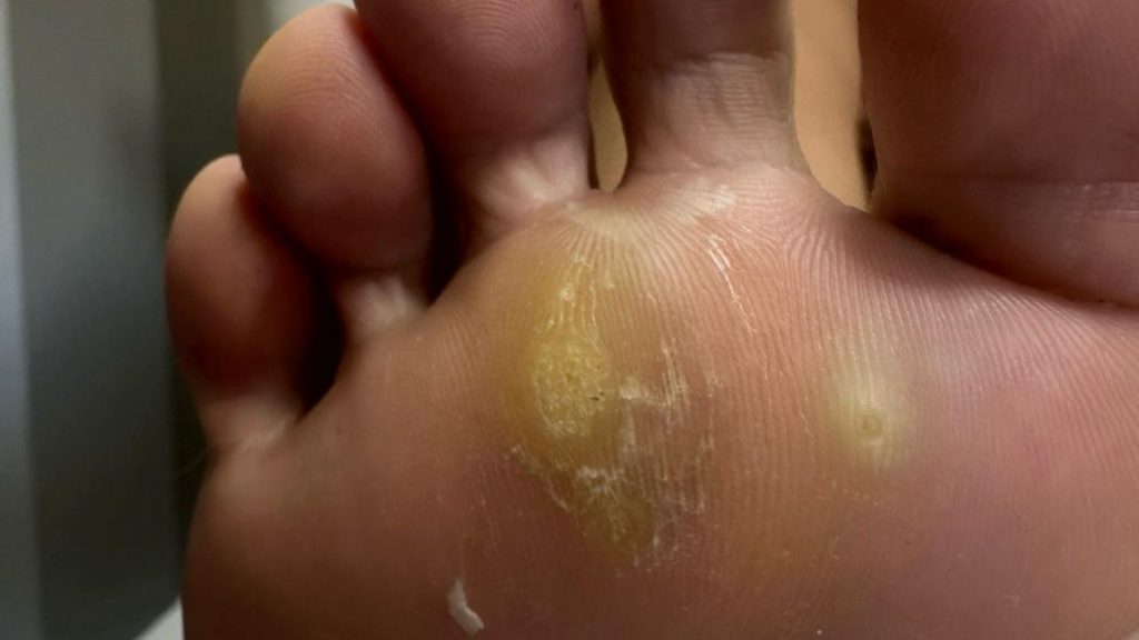 Veruca plantară (negi în talpă): de ce apare, cum se manifestă și cum poate fi tratată