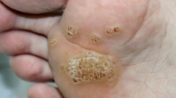 Verucă plantară localizată la în talpă