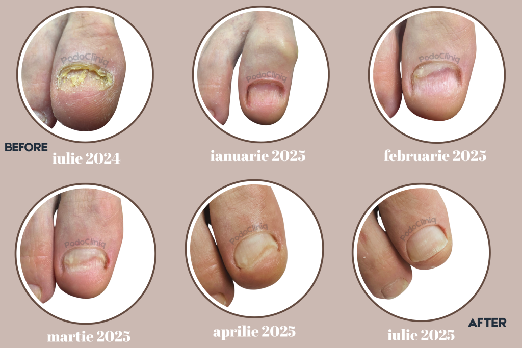  Tratament onicomicoza (ciuperca unghiei) cu laser Lunula, igienizări, terapii topice | PodoCliniq