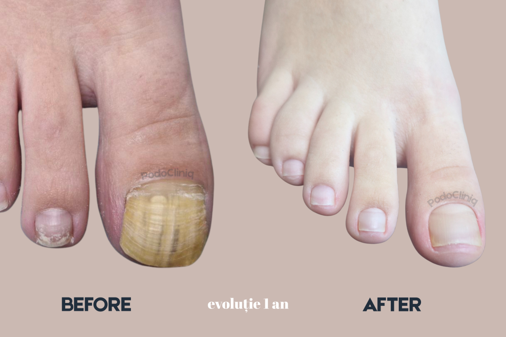  Tratament onicomicoza (ciuperca unghiei) cu laser Lunula, igienizări, terapii topice | PodoCliniq