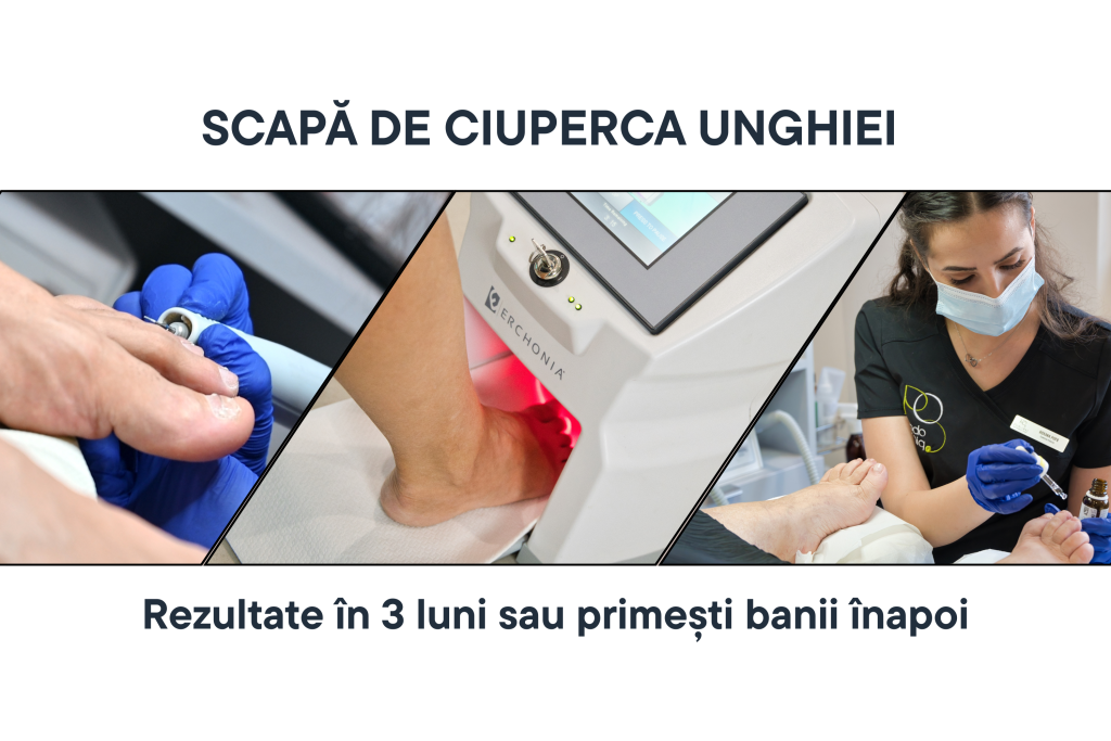  Tratament onicomicoza (ciuperca unghiei) cu laser Lunula, igienizări, terapii topice | PodoCliniq