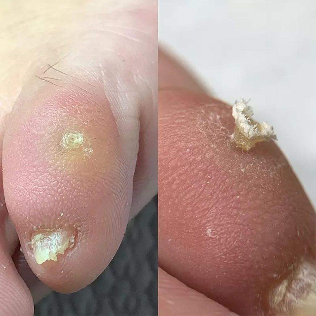 Clavus plantar (bătăturile cui): Semnele care indică această afecțiune și cum o tratezi