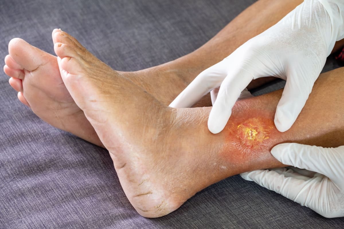 Rolul chirurgiei în tratarea piciorului diabetic: când este necesară?