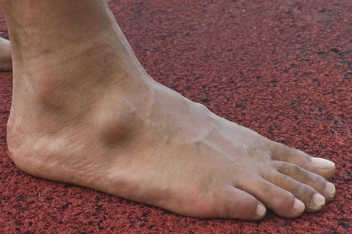 Cum recunoști un chist sinovial pe picior și ce trebuie să faci?