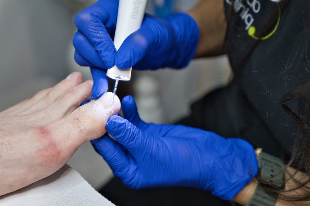  Tratament onicomicoza (ciuperca unghiei) cu laser Lunula, igienizări, terapii topice | PodoCliniq