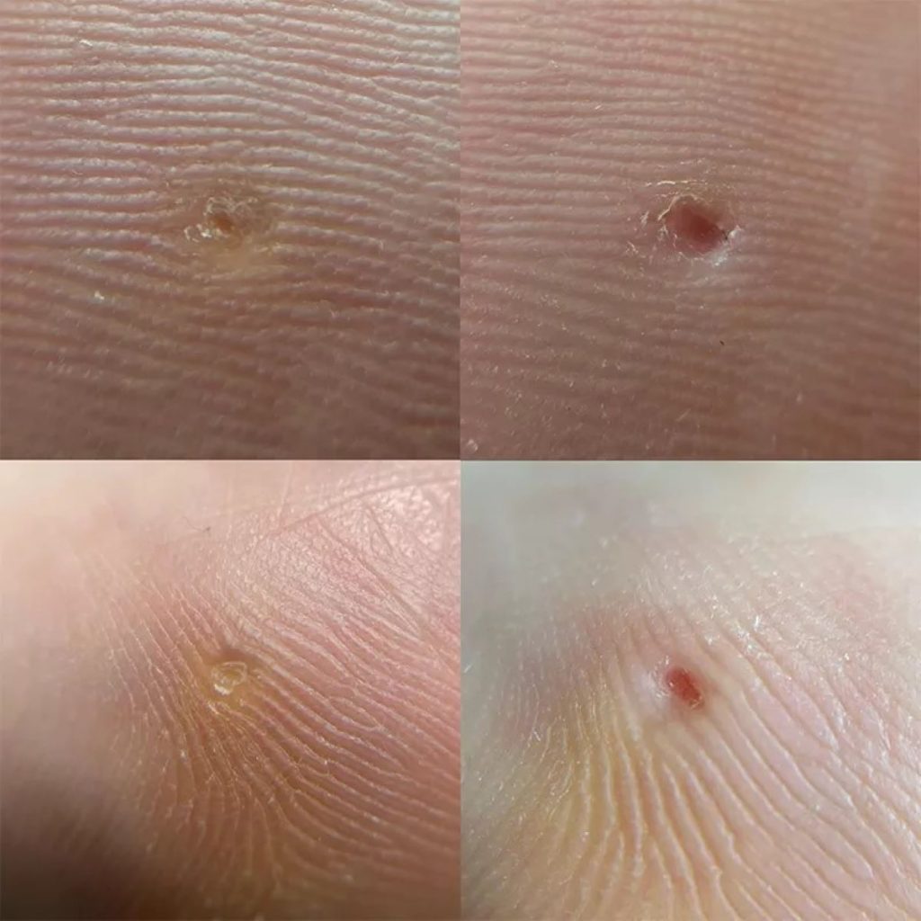 Clavus plantar (bătăturile cui): Semnele care indică această afecțiune și cum o tratezi